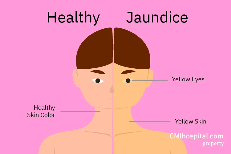 gambar Jaundice, Penyakit Kuning Penanda Penyakit Mematikan